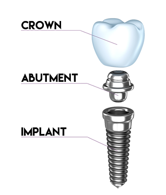 Dental Implants Dental Implants Illustration