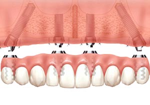 Denture Replacement Secure Dentures