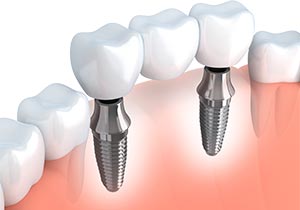 Multiple Tooth Replacement Implant Supported Bridge