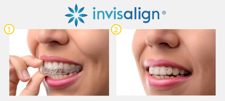 Invisalign Instructions Invisalign Instructions