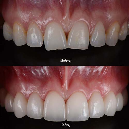 Before & After Porcelain Veneers Smile Makeover