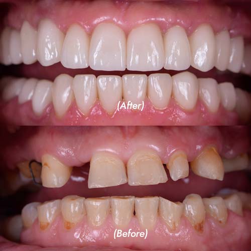 Dental Implants Smile Makeover