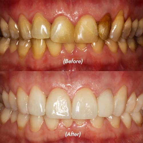 Smile Makeover With Teeth Whitening