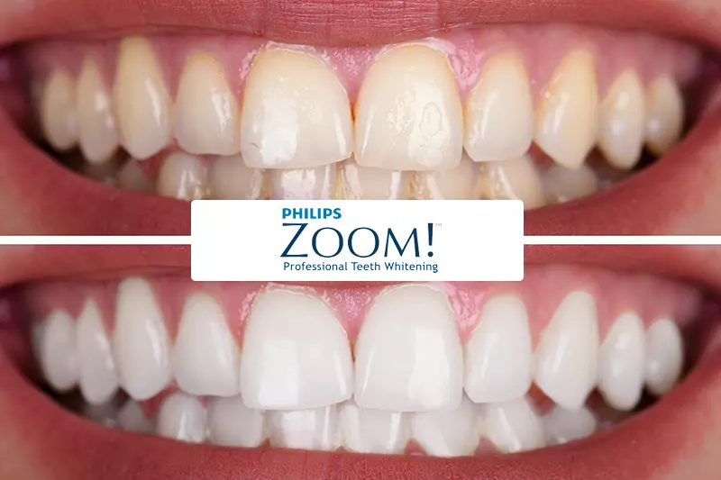 Philips Zoom! Teeth Whitening Before & After